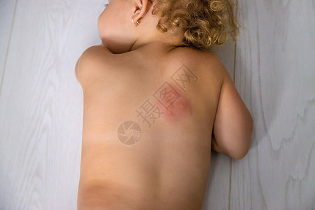 蚊子咬回一个孩子 有选择的焦点婴儿女孩奶油皮疹昆虫男生横幅划痕身体药品图片