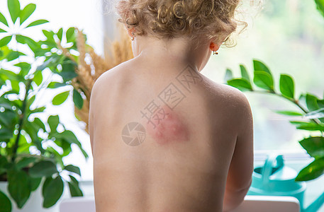 蚊子咬回一个孩子 有选择的焦点皮炎横幅男生婴儿漏洞疾病皮疹药品身体奶油图片