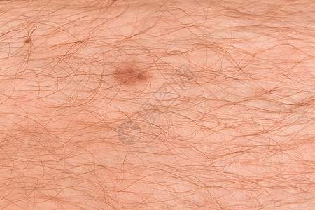 男人毛毛腿皮肤上的红伤 紧贴疾病创伤宏观痛苦膝盖伤害药品成人划痕治疗图片