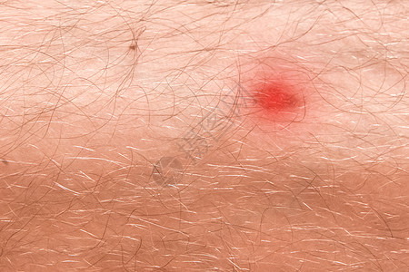 男人毛毛腿皮肤上的红伤 紧贴女性药品组织医院痛苦身体伤害瘢痕愈合疼痛图片