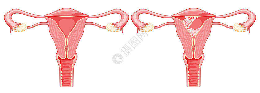 子宫内女性生殖系统疤痕组织粘合症 切开前视线病态和正常器官骨盆生物学输卵管药品癌症插图腹部女性女士图片