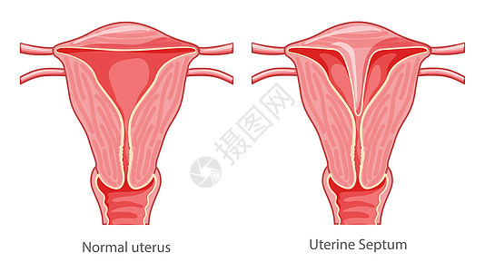 一组子宫隔膜子宫女性生殖系统图正常并伴有疾病疼痛 切割前视图图片
