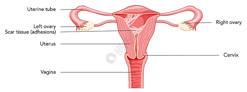 子宫图中的女性生殖系统疤痕组织粘合 上面有刻有字的表象 前视排卵生殖器器官女士妇科癌症身体卵巢药品图表图片