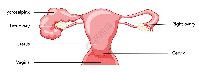 女性生殖系统堵塞了输卵管子子宫 并描述其特征;人体解剖内器官背景图片