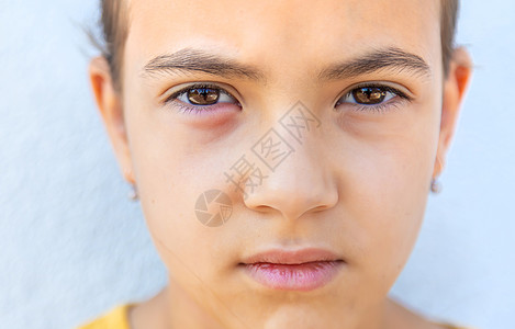 儿童眼神发炎 有选择的焦点疼痛眼球症状细菌瘙痒卫生损害过敏青光眼瞳孔图片