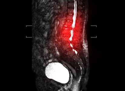 MRI Lumbar脊椎长尾T2W脂肪抑制骨科绳索医学疼痛谐振外科考试压缩腰背疾病图片