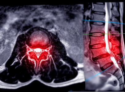 MRI LS 脊椎或腰脊轴轴T2W视图 带有人造平面神经影像疝气扫描器扫描谐振解剖学椎骨医学椎间图片