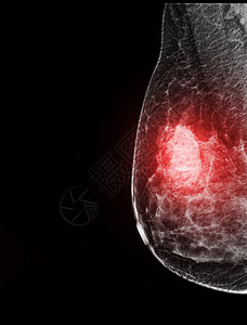 X射线数字乳房造影或乳房X光照相胸部手术生长考试乳腺检查剪裁照片医院疾病图片