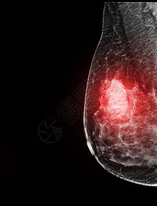X射线数字乳房造影或乳房X光照相胸部手术生长考试乳腺检查剪裁照片医院疾病背景图片