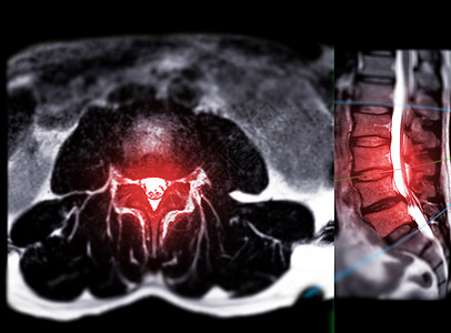 MRI LS 脊椎或腰脊轴轴T2W视图 带有人造平面扫描器光盘椎间技术身体影像骨科诊断手术医院图片