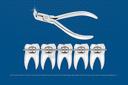 3d 矢量图 逼真的牙齿 上下颌有牙套 对齐牙齿的咬合 牙列与牙套 牙套牙疼诊所牙刷矫正支撑医生曲线牙医卫生微笑图片