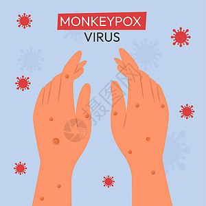 猴痘爆发 猴痘出现在病人的手上 用于告知人们传染病的平面矢量图发烧皮疹传染性皮肤症状疫苗科学疾病卡通片诊断图片