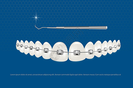 3d 矢量图 带牙套的逼真牙齿 对齐牙齿的咬合 牙列与牙套 牙套牙医治疗医生牙疼药品牙刷卫生支撑矫正凹痕图片