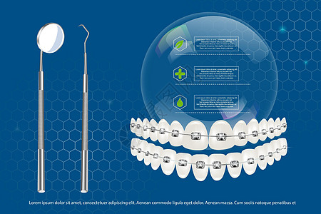 3d 矢量插图 逼真的牙齿 在信息图表和工具的背景下带有上下颌牙套 对齐牙齿的咬合 牙列与牙套 牙套图片