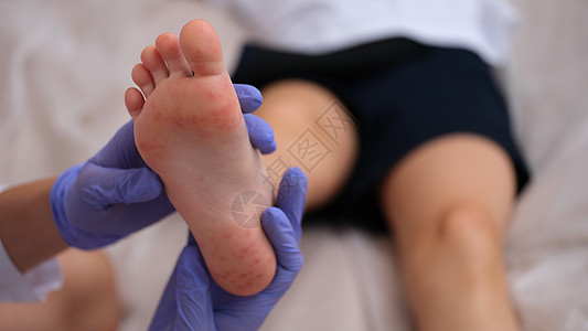 传染病医生检查儿童脚皮皮皮皮皮皮疹 闭合图片