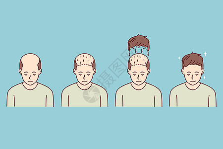 男子理发移植阶段损失卫生插图保健状况程序诊所脱发头发秃顶图片