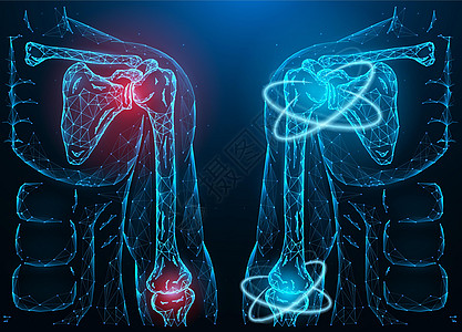 患病发炎的人肩肘关节的多边形矢量图和肩肘功能的恢复 医疗横幅 模板或背景图片