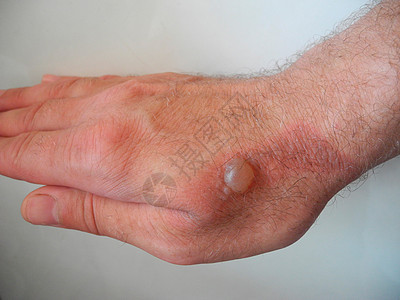 灰色背景的男性手上可怕的灼伤创伤感染疼痛皮肤帮助医疗伤口瘢痕烧伤白色图片