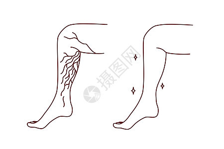 静脉变动的病人腿卡通片血栓疼痛浮肿曲张成人插图动脉身体保健图片