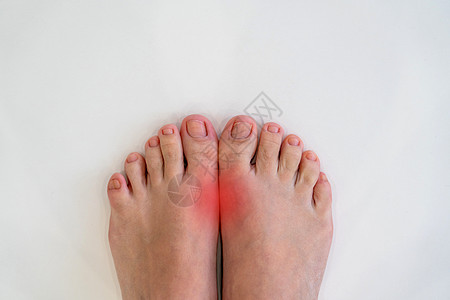 风湿病和痛风病 大脚趾与红点接头的疼痛性口味炎症女性痛风女士手指疾病风湿痛苦药品疼痛医疗背景图片