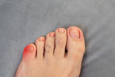 红点女性脚的火焰 脚痛和疾病的概念妇女脚部炎热 红点风湿病医疗伤害脚趾手指疼痛痛苦扭伤女士风湿图片
