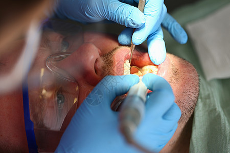男人在牙科诊所闭合时治疗牙齿图片