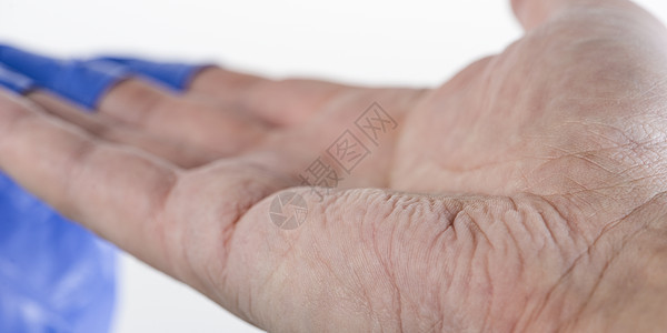 医生摘下他的蓝色橡胶手套 手上的皮肤因潮湿而起皱 长时间戴橡胶手套后手指起皱橡皮白色卫生皱纹男人拇指棕榈药品时间手势图片
