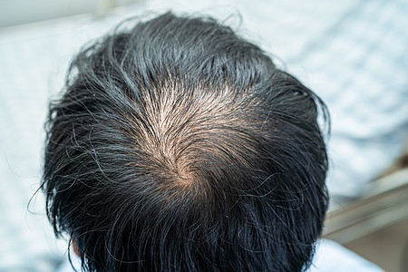 被中头顶秃头 开始不掉头发的光彩 成熟的亚洲商业机智活跃办公人员脱发白色发型男人药品黑色卫生移植秃顶治疗图片
