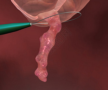 阑尾炎是指阑尾的炎症 指状囊从腹部右下侧的结肠突出厌食症药品痛苦愈合身体情况攻击消化经期按摩图片