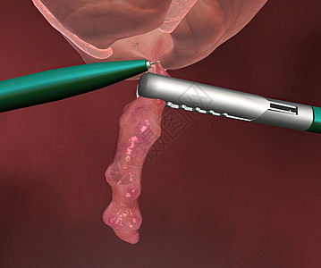 阑尾炎是指阑尾的炎症 指状囊从腹部右下侧的结肠突出身体情况攻击按摩厌食症医院癌症愈合疼痛消化图片