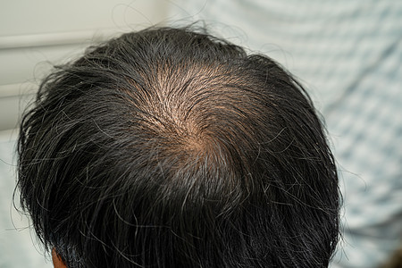 被中头顶秃头 开始不掉头发的光彩 成熟的亚洲商业机智活跃办公人员男性白色黑色保健移植治疗损失女性脱发男人图片