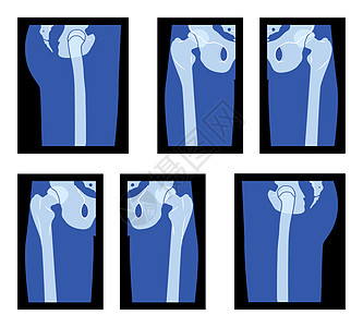一组X光Hip和Leg 股骨头 Skeleton人体骨骼成人骨质动物 背面视线是伦琴图片