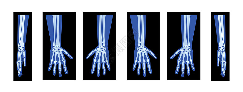 一组X光手与半径 人体 骨骼成年人的伦琴前侧视角图片