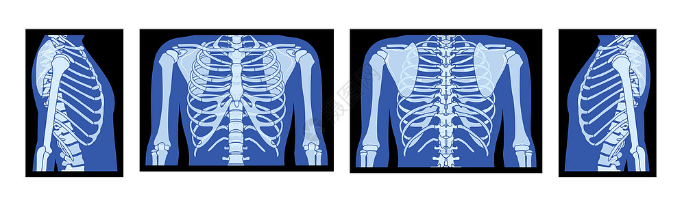 一组X射线肋骨笼子和手 Skeleton人体骨质骨质成年者 龙根前侧观点图片