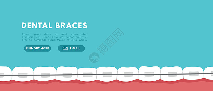 牙牙套横幅 正统问题 带括号的微笑 预留符 Flat 矢量孤立插图假牙支撑陶瓷空腔金属口腔科矫正磨牙结盟牙齿图片