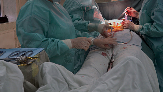 医院的手术室是冠状动脉旁路移植术 CABG 作为心脏病手术的一部分进行的地方图片