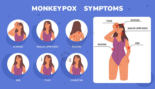 猴痘病毒症状医学手册 病毒症状模板 发烧 头痛 皮疹 带有猴痘病毒症状的信息海报 保健和医疗图片