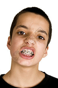 向青少年展示他的牙套图片