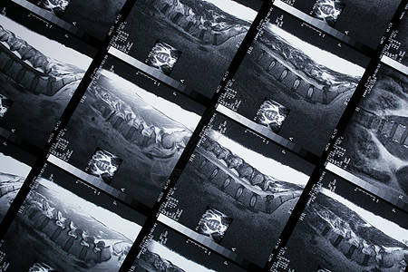 x射线柱子药品扫描器核磁共振脊柱骨盆医疗医院外科断层图片