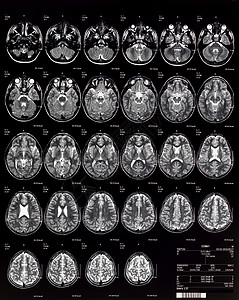 脑MRI儿童(10岁)图片