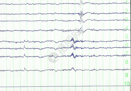 电子脑电图心电图思维海浪标志科学频率电极癫痫药品勘探图片