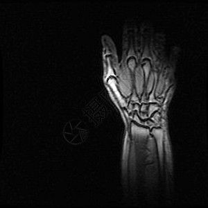 X射线手手指手腕关节炎射线腕关节软骨痛风图片