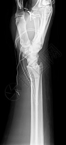 X射线手射线手指痛风软骨关节炎腕关节手腕图片