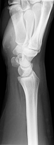 X射线手射线关节炎手指软骨痛风手腕腕关节图片