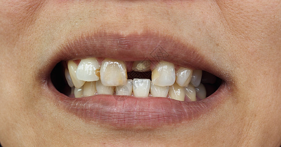 牙牙缝合坏牙齿高清图片