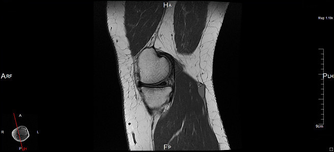 磁共振成像器官考试肌肉白色黑色关节辐射左膝神经软骨背景图片