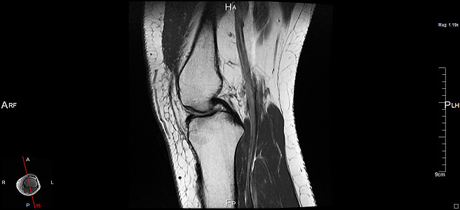 磁共振成像肌肉器官黑色白色左膝软骨身体考试神经辐射图片