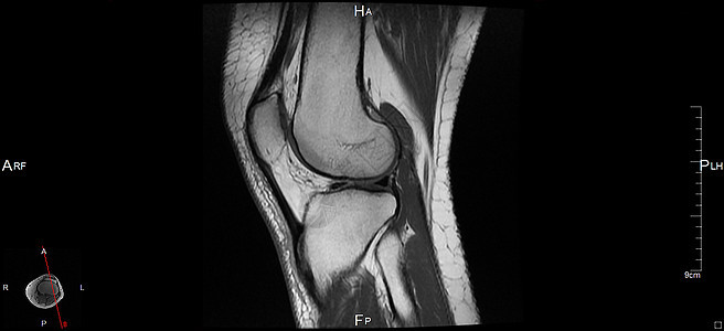 磁共振成像软骨关节身体神经左膝器官白色肌肉辐射黑色背景图片
