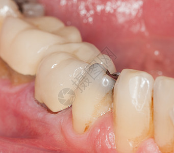 填满牙齿的宏图像牙医衰变疾病唾液舌头病理临床合金牌匾变色图片
