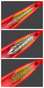 血管成形术动脉血栓系统动脉粥样硬化呼吸困难程序手术插图心脏病主动脉图片
